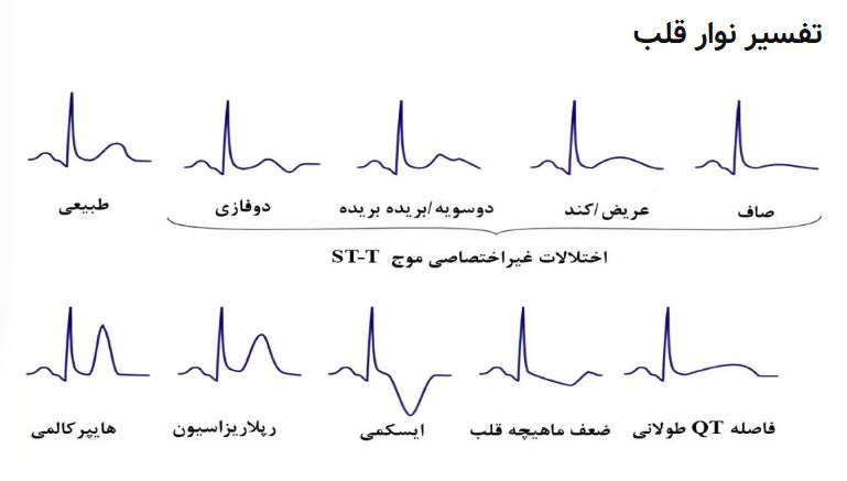 تفسیر نتایج نوار قلب