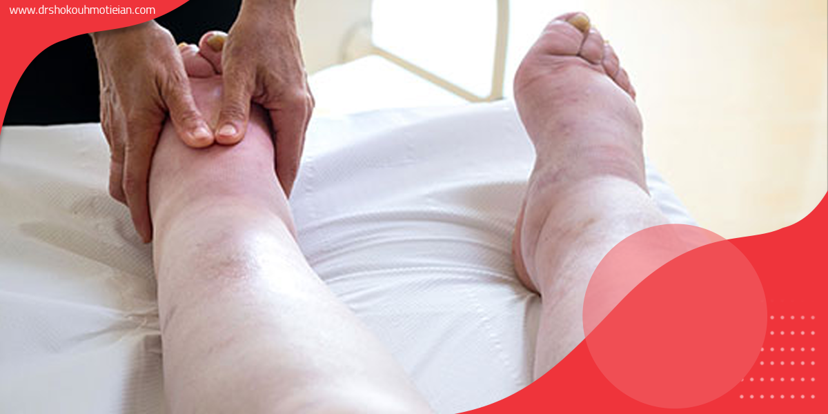 تشخیص بیماری ادم