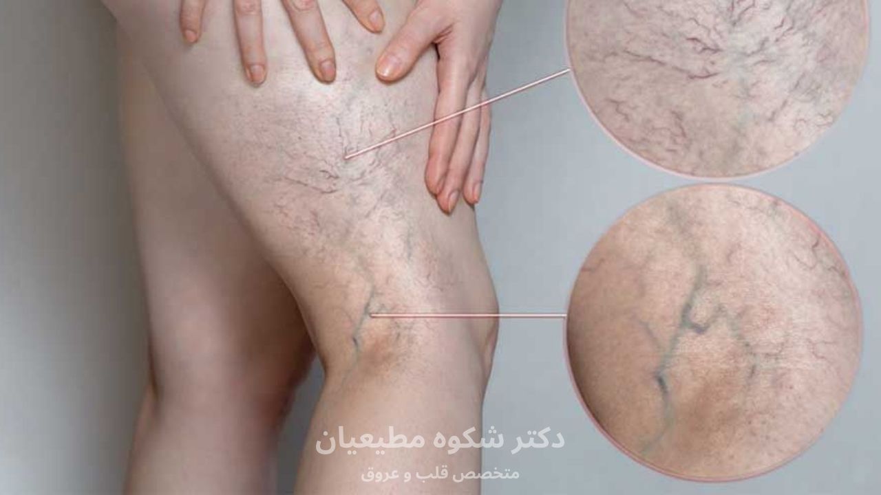 علائم و نشانههای واریس پا
