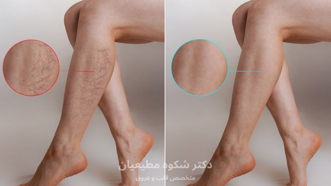 لیزر بهتر است یا فوم/جراحی/رادیوفرکوئنسی؟