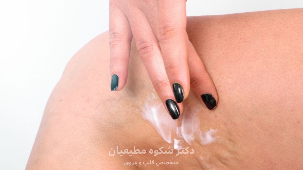 پماد واریس پا چگونه عمل میکند؟