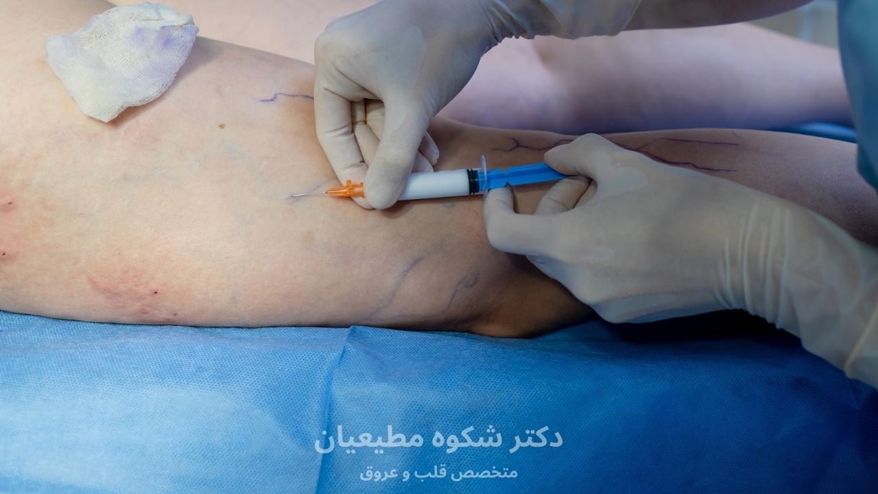 تفاوت اسکلروتراپی با لیزر واریس