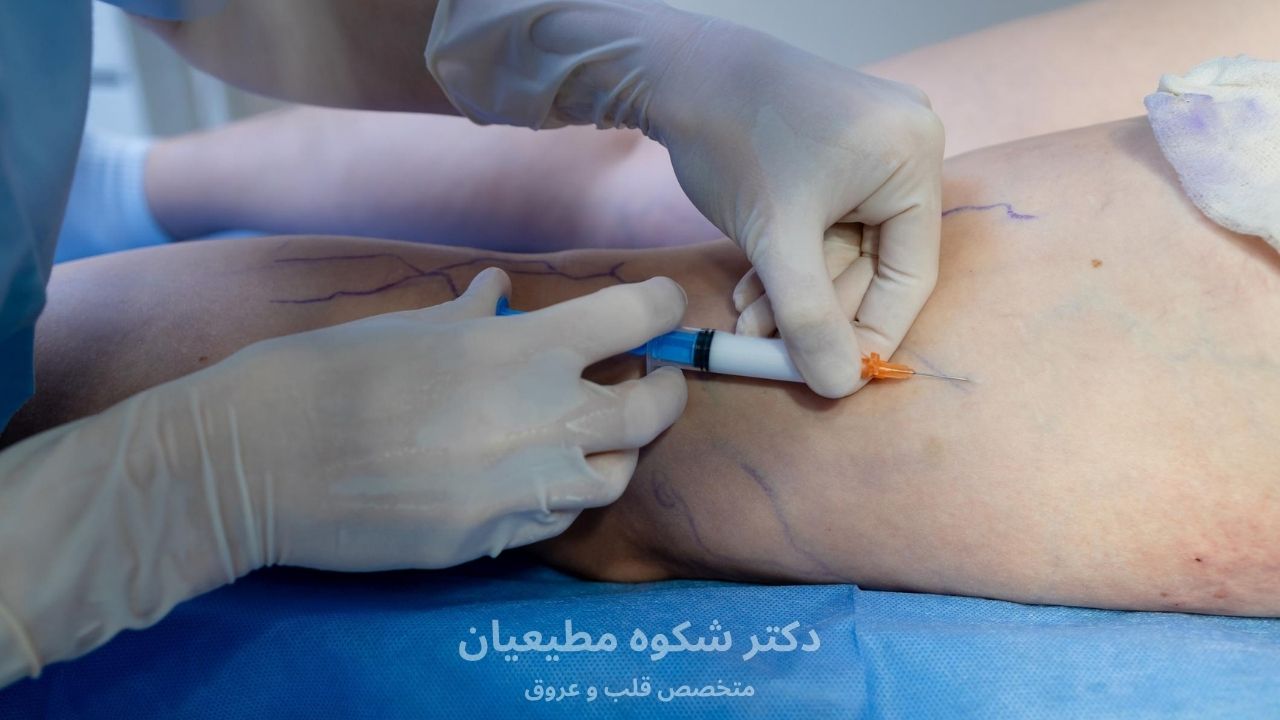 اسکلروتراپی برای چه افرادی مناسب است؟