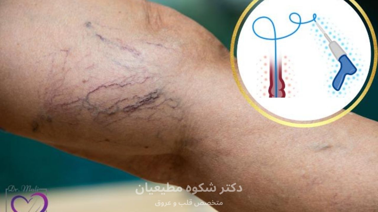 چه کسانی میتوانند از چسب واریس استفاده کنند؟