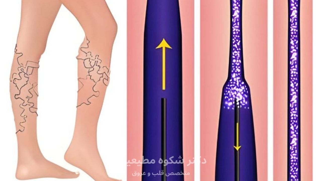 چسب واریس پا چگونه عمل میکند؟